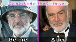 Sean Connery Plastic Surgery Photos Before After