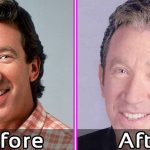 Tim Allen Plastic Surgery - Face Lift Photos Before After