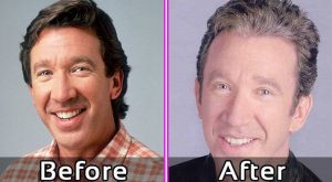 Tim Allen Plastic Surgery - Face Lift Photos Before After