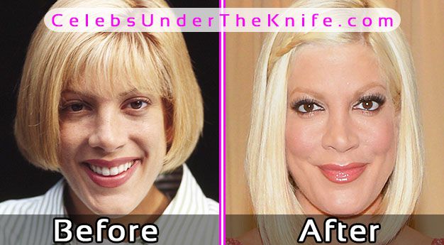 Tori Spelling Before After Plastic Surgery Pics
