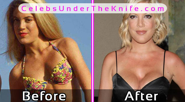 Tori Spelling Breast Augmentation Disaster Photos