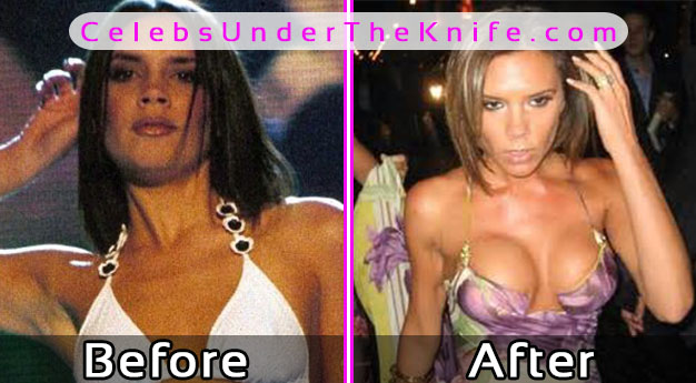 Victoria Beckham Boob Job Disaster Before After