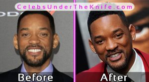 Will Smith Plastic Surgery Before After