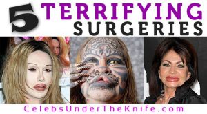 5 Terrifying Plastic Surgery Photos - Before and After