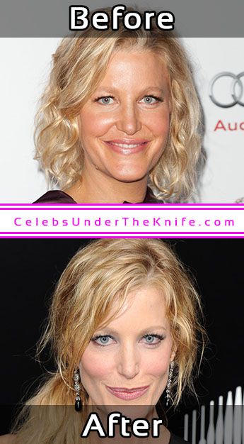 Anna Gunn Photos Cosmetic Surgery