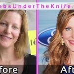 Anna Gunn Plastic Surgery Photos Before After