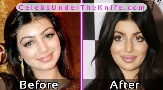 Ayesha Takia Bollywood Actress Before After Surgery