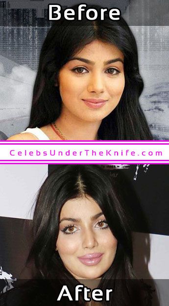Ayesha Takia Plastic Surgery Bollywood Actor