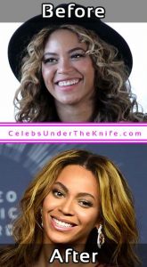 Beyonce Pics Before After Cosmetic Surgery