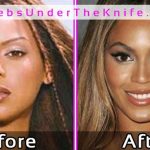 Beyonce Plastic Surgery Photos Before After