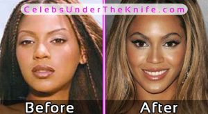 Beyonce Plastic Surgery Photos Before After