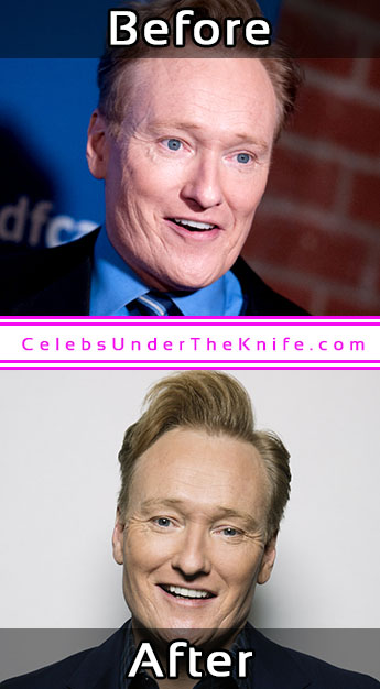 Conan O’Brien Photos Cosmetic Surgery