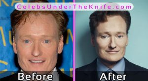 Conan O’Brien Plastic Surgery Photos Before After
