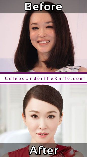 Fann Wong Photos Cosmetic Surgery