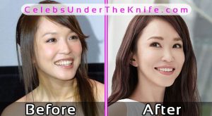 Fann Wong Plastic Surgery Before After Photos