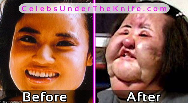 Hang Mioku Before After Plastic Surgery Disaster