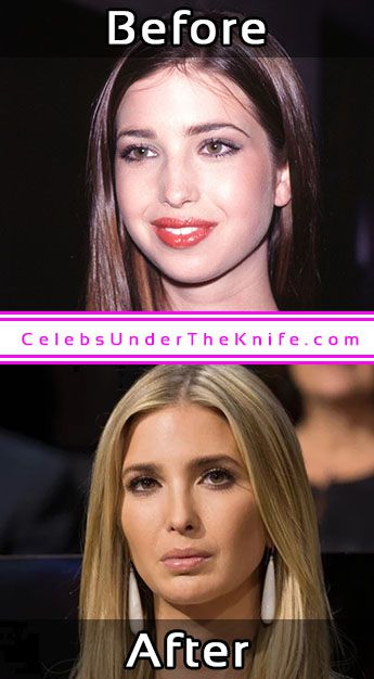 Ivanka Trump Photos Plastic Surgery