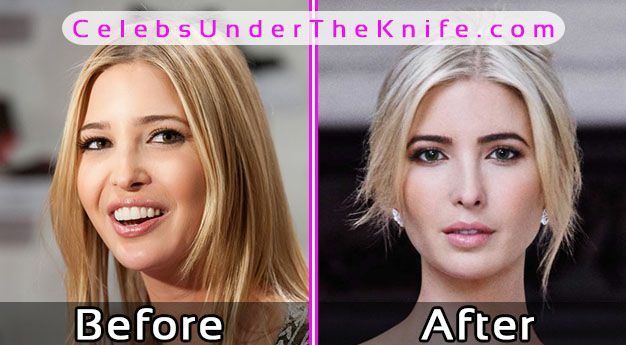 Ivanka Trump Plastic Surgery? Before After Pics