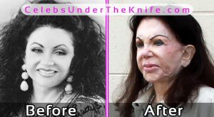 Jackie Stallone Plastic Surgery Disaster Gone Wrong