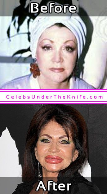 Jackie Stallone Plastic Surgery Photos