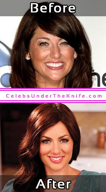 Jillian Harris Photos Cosmetic Surgery