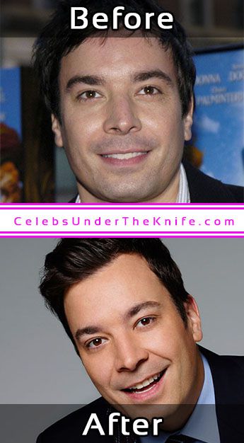 Jimmy Fallon Cosmetic Surgery Photos