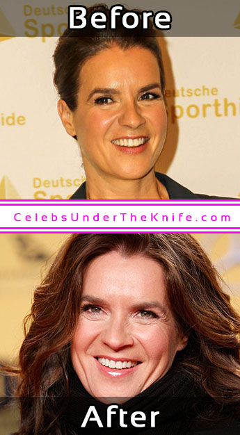 Katarina Witt Photos Cosmetic Surgery