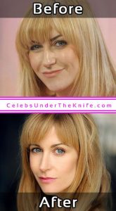 Katherine Kelly Pics Cosmetic Surgery