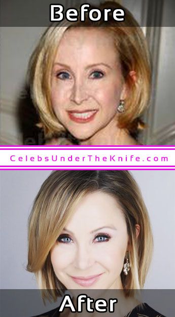 Lisa Breckenridge Photos Cosmetic Surgery