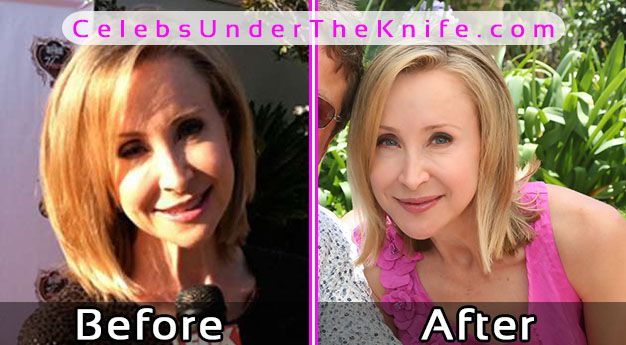 Lisa Breckenridge Plastic Surgery Photos Before After