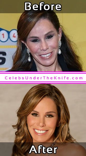 Melissa Rivers Photos Cosmetic Surgery