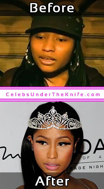 Nicki Minaj Plastic Surgery Before and After – Celebrity Dr.