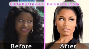 Nicki Minaj Plastic Surgery Pics Before After