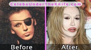 Pete Burns Plastic Surgery Before After Photos