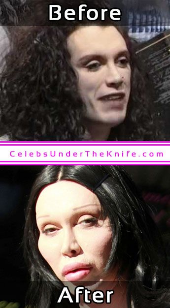 Pete Burns Plastic Surgery Disaster Photo