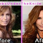 Tracey Bregman Photos Before After Plastic Surgery
