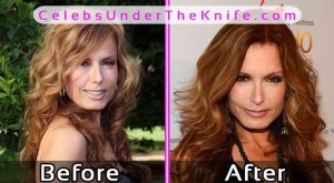 Tracey Bregman Photos Before After Plastic Surgery