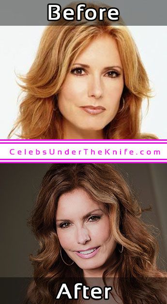 Tracey Bregman Surgery Before After Photos