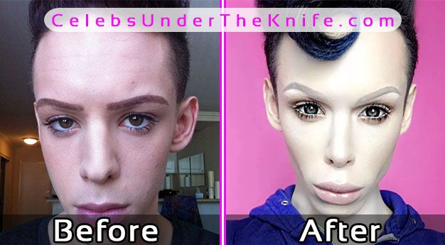 Vinny Ohh ALIEN Plastic Surgery Before After Photos
