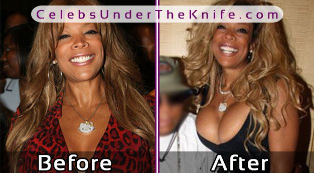 Wendy Williams Cosmetic Procedure Rumors