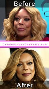 Wendy Williams Photos Cosmetic Surgery