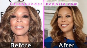 Wendy Williams Plastic Surgery Photos Before After