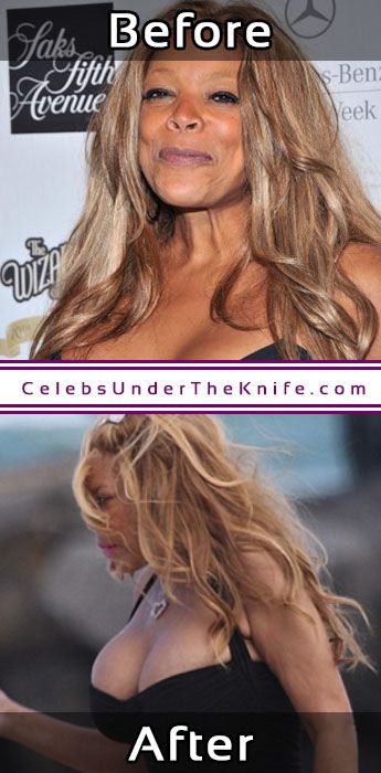 Wendy Williams Plastic Surgery Results