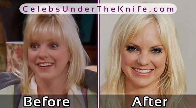 Anna Faris Cosmetic Procedure Results