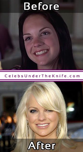 Anna Faris Nose Job Allegations