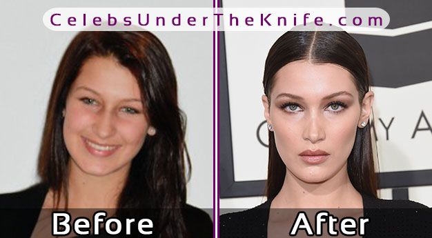 Bella Hadid Before Surgery