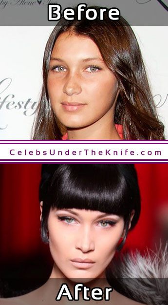 Bella Hadid Cosmetic Procedure Nose Job Photo