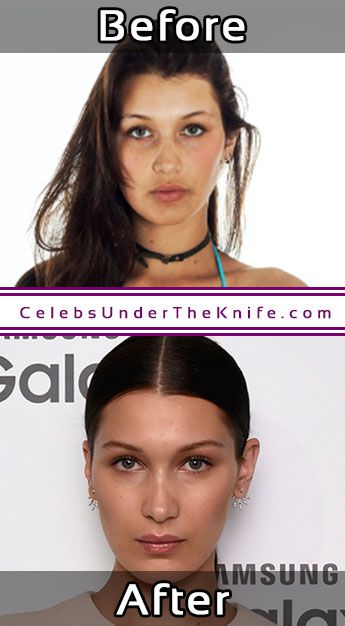 Bella Hadid Photos Before + After Surgery