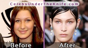 Bella Hadid Plastic Surgery Before After