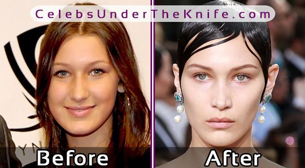 Bella Hadid's Nose Job? Before After Photos Ready